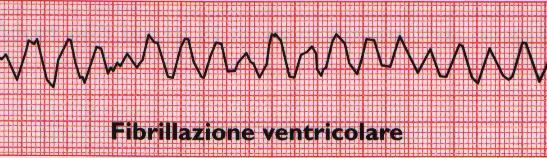 Fibrillazione ventricolare Assenza di ritmo con QRS riconoscibili Presenza di ondulazioni più o meno grossolane dell isoelettrica Comporta arresto cardiaco per assenza di