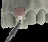 BL BONE Level implant ABUTMENT PROVVISORI ABUTMENT DIRITTO Ø 5 IN PEEK Abutment preangolato 15 in fibra di vetro vite inclusa vite inclusa H1 H2