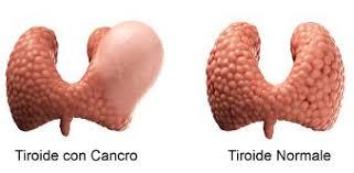 CARCINOMA DELLA TIROIDE Il carcinoma della tiroide è una neoplasia rara in quanto costituisce il 2% di tutti i tumori.