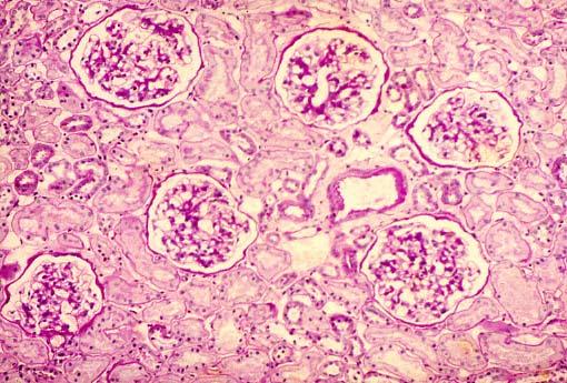 Glomerulosclerosi diffusa.