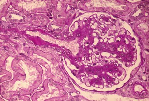 Glomerulosclerosi diffusa.