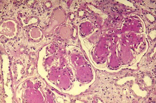 Glomerulosclerosi nodulare.