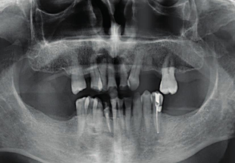 L implantologia come ancoraggio ortodontico: caso clinico Autori_P. Borelli*, U. Marchesi** & F.