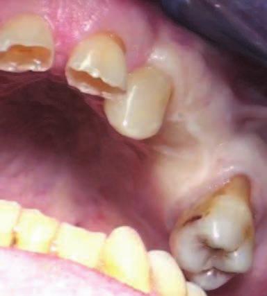 All esame obiettivo appare evidente lo stato di usura degli elementi dentari presenti, la mancanza di supporto posteriore e una malocclusione caratterizza da rapporti tendenti alla terza classe