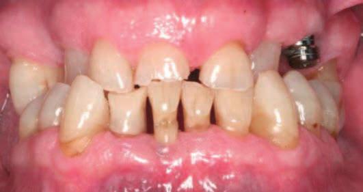Si notino il rialzo occlusale e le macchie sui denti dovuti ai quotidiani sciacqui con clorexidina 0.12%.
