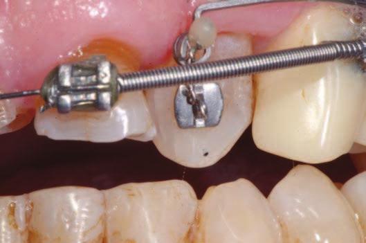 Alla ine della terapia viene consegnata la contenzione per stabilizzare la posizione dei denti e il caso