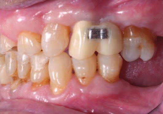 Inoltre, viene agevolata anche la correzione delle inclinazioni sfavorevoli dei denti, necessaria per evitare l insorgere di problematiche parodontali.