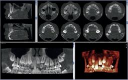 Il protocollo di imaging unico e pionieristico si basa su algoritmi 3D intelligenti sviluppati appositamente da Planmeca.