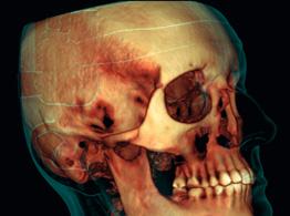 ortodontici per l analisi cefalometrica Immagini postoperatorie e di follow-up nella chirurgia maxillo-facciale Studi delle vie aeree Studi del seno Pianificazione impianto Imaging 3D con una dose