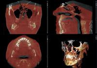 Utilità della diagnosi 3D La visualizzazione del rendering 3D di Planmeca Romexis fornisce una panoramica immediata dell anatomia e costituisce un eccellente strumento di educazione per il paziente.