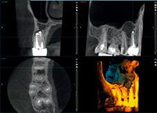 L unità è anche particolarmente adatta ai casi endodontici complessi, poiché in un volume 3D si possono osservare tutte le informazioni.