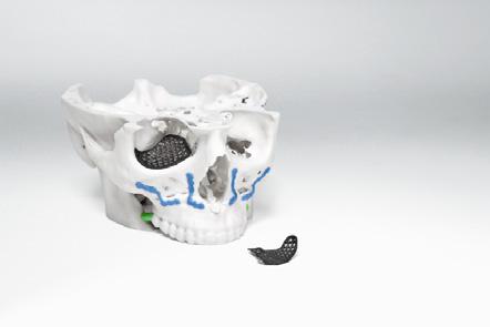 Il servizio comprende anche modelli fisici 3D del cranio e guide chirurgiche per assistere sia