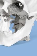 3D sono progettati in una sessione on-line tra il chirurgo e il progettista Planmeca Ordinare è