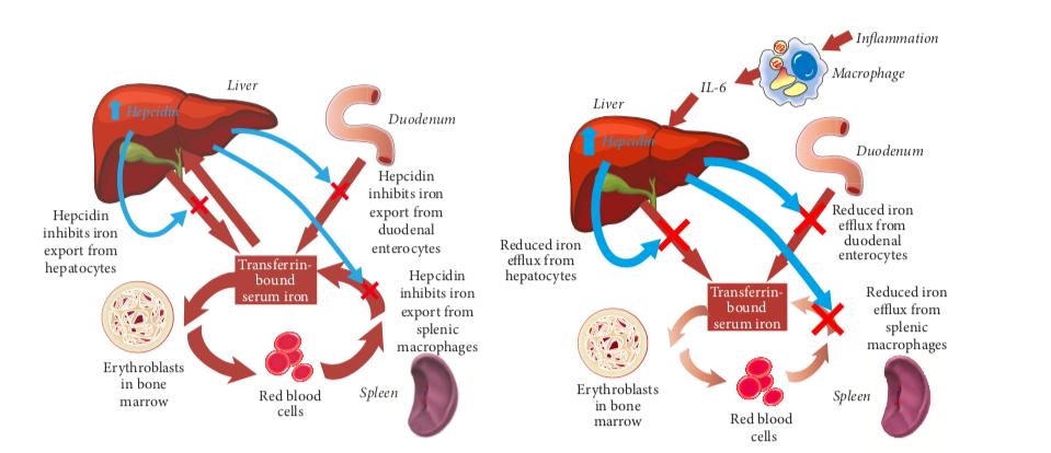 DIFETTI DEL RICICLO del FERRO ANEMIA DEI DISORDINI CRONICI O DELL INFIAMMAZIONE Patogenesi multifattoriale: ridotta increzione di EPO