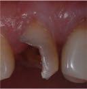 Vengono così coinvolti gli aspetti endodontici, parodontali e restaurativi dei denti compromessi.