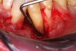 problemi endodontici: Il