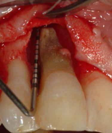 parodontali: La chirurgia parodontale