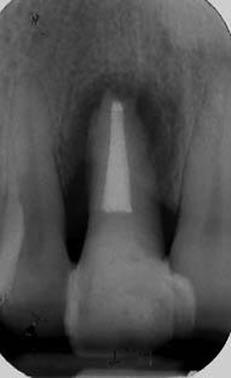 e timing terapeutici Il dente a