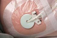 condizioni (cute sudata o patologica) CDC ATLANTA 2002 Use either sterile gauze or sterile, transparent, semipermeable dressing to cover the catheter site.