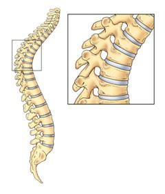 DORSO CURVO GIOVANILE O MALATTIA DI SCHEUERMANN. La parte frontale delle vertebre si sviluppa più lentamente della parte posteriore.