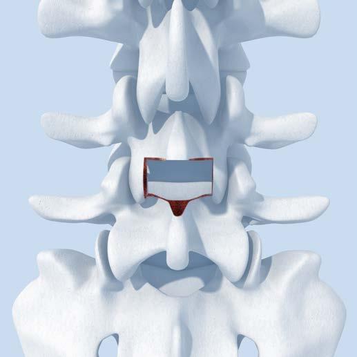 002 Set di divaricatore Insight, configurazione standard Resezionare l anatomia posteriore ed eseguire la discectomia.
