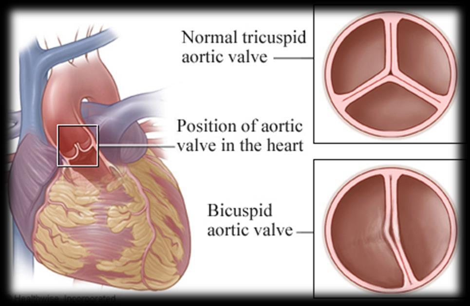 Valvola tricuspide Presente a livello dell ostio atrio-ventricolare dx.