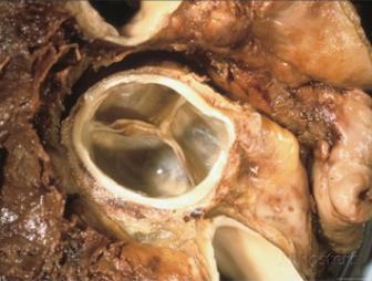 La valvola atrioventricolare destra (tricuspide), è composta da tre lembi che sono ancorati all anello fibroso che circonda l