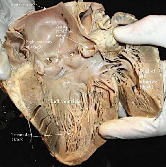 La superficie interna del ventricolo sx è irregolare per la presenza di rilievi miocardici: colonne carnose.