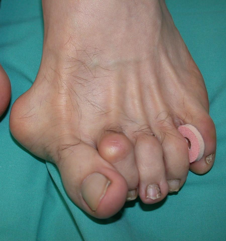 Tommaso anni 76 Scarsi disturbi solo con calzature particolari Importante valgismo con artropatia MF1