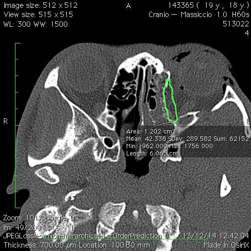 ciascun taglio per ottenere il volume di tessuto erniato.