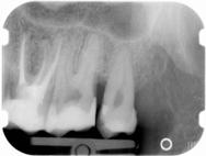 nella funzione, e perdita del contatto col dente anteriore (col conseguente intasamento alimentare vedi Conservativa).