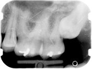 A sinistra. S intravvede nel mascellare superiore, dietro al dente 2.7 (7 ) la cuspide di un dente del giudizio 2.8 semincluso. A destra.