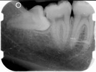 Nella radiografia si vede Il dente del giudizio 4.