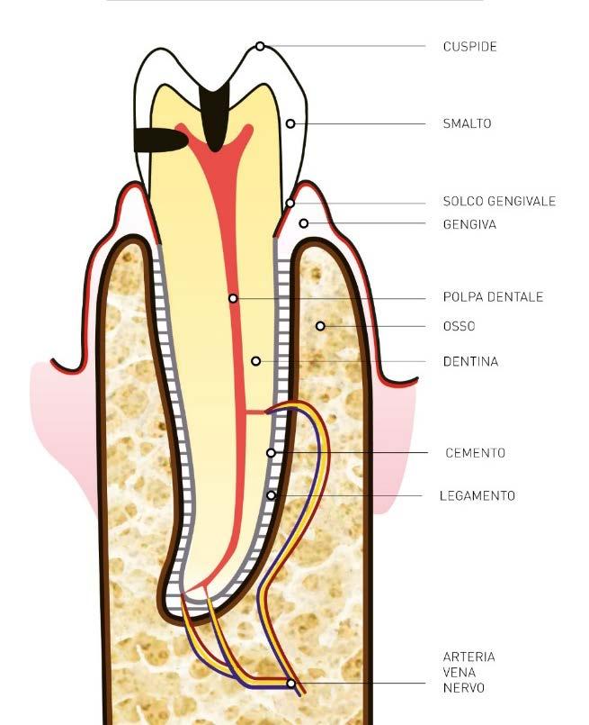 Carie profonda in dentina e Otturazione profonda in dentina La sintomatologia della carie è logicamente assente, se il dente è devitalizzato!