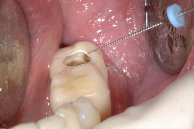 La diga è un foglio quadrato di gomma (vinile), sul quale vengono fatti dei fori, attraverso i quali si fanno passare il dente o i denti da curare.