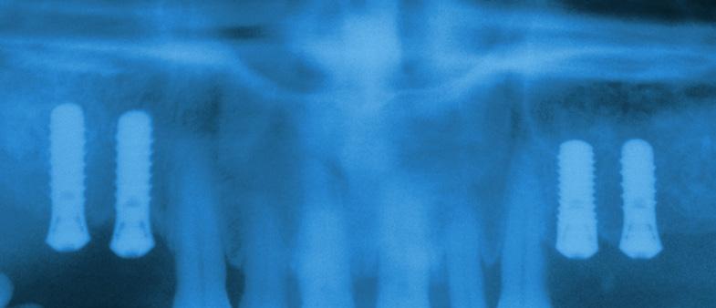 Indicazioni Cliniche S1 Rialzo del seno mascellare Concetto di trattamento del Dr.