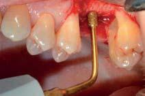 inserto per osteotomia e osteoplastica Û OT11 osteotomia o osteoplastica micrometrica erosione corticale basale