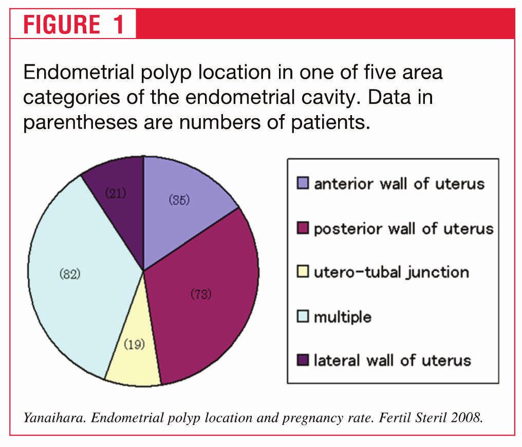 Su 230 pazienti infertili: 8,3% giunzione uterotubarica 15,2% parete