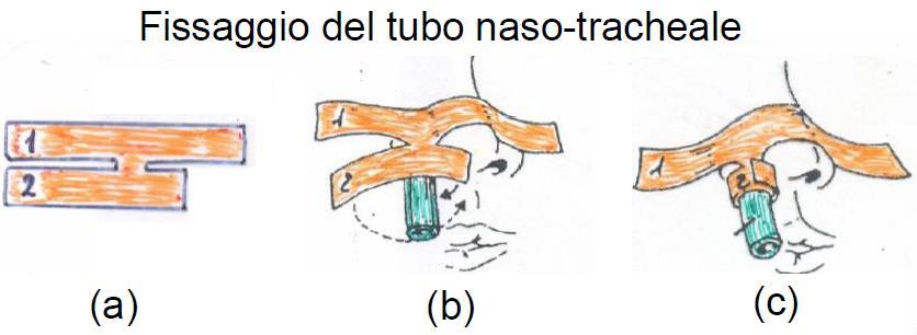 c) procedura a) b) Porre la testa del neonato in sniffing