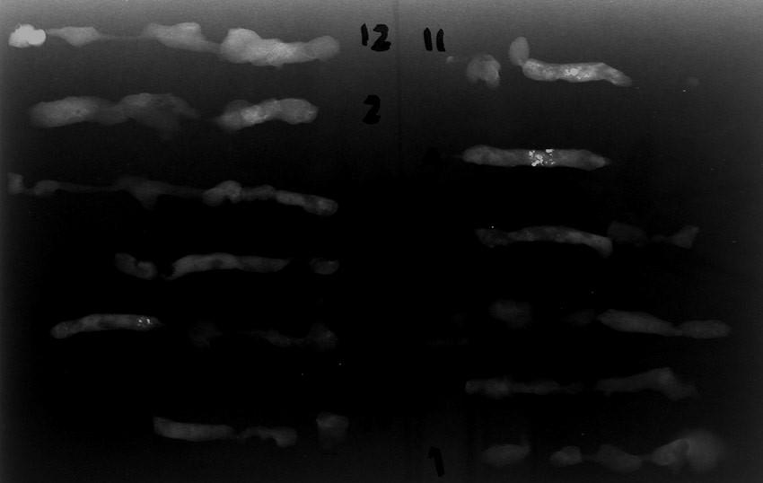 In tutti i 34 casi in cui il bersaglio della biopsia erano le microcalcificazioni è stato eseguito