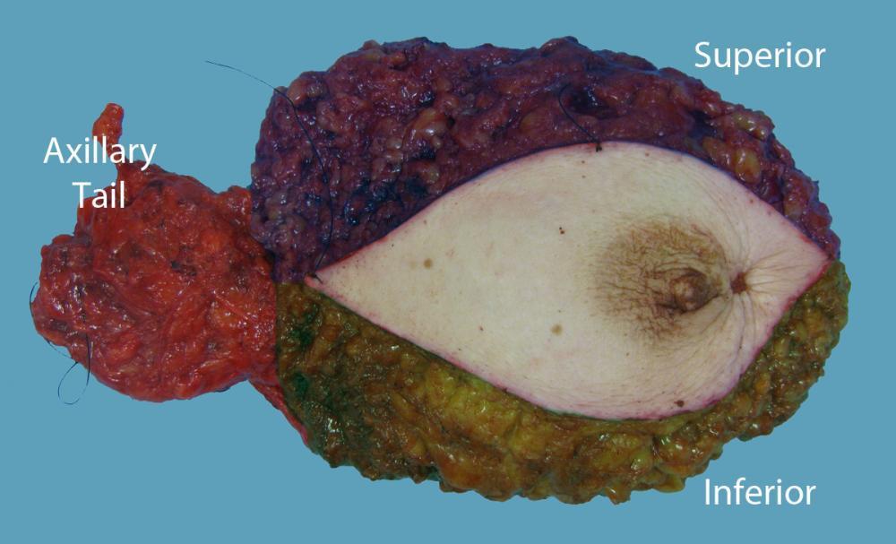 Quale chirurgia dopo chemioterapia neoadiuvante? La chemioterapia neoadiuvante consente il down-staging della neoplasia e quindi una chirurgia meno invasiva.