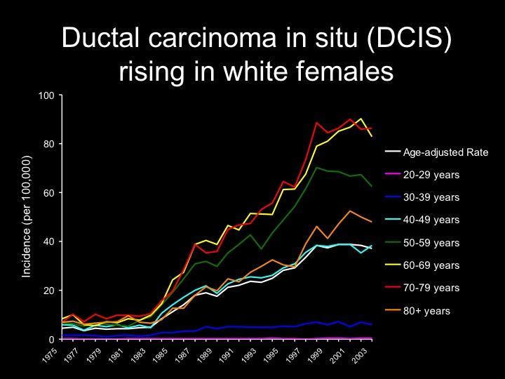 Il carcinoma duttale in situ (DCIS) è diventata un entità molto più frequente negli