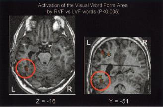 VISUAL WORD FORM AREA (VWFA) Attivazioni fmri in corteccia occipitotemporale mediale per lettere (vs.