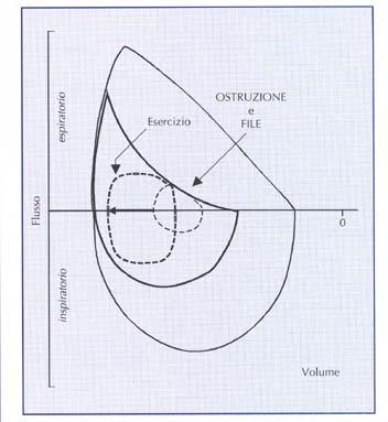 Litri 0 BPCO: DIAGNOSI SPIROMETRIA FEV1 FVC FEV1/FVC Normale 4.150 5.