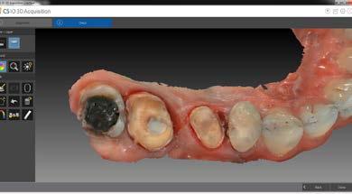 PERFETTO PER TUTTE LE PROCEDURE DENTALI I nostri scanner intraorali migliorano l efficienza semplificando e accelerando il processo di creazione delle impronte digitali e dei modelli digitali.