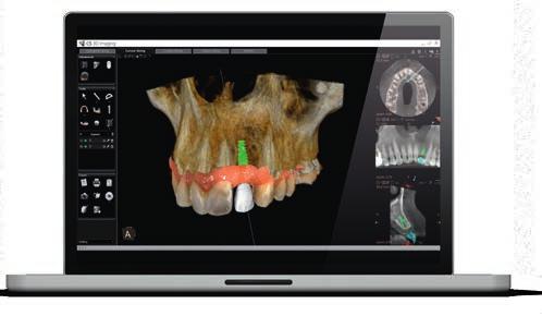 PIANIFICAZIONE DI IMPIANTI, IN MODO AFFIDABILE CS 3600 offre un flusso di lavoro di scansione dedicato per protesi implantare Una scansione molto accurata, per una pianificazione degli impianti e per