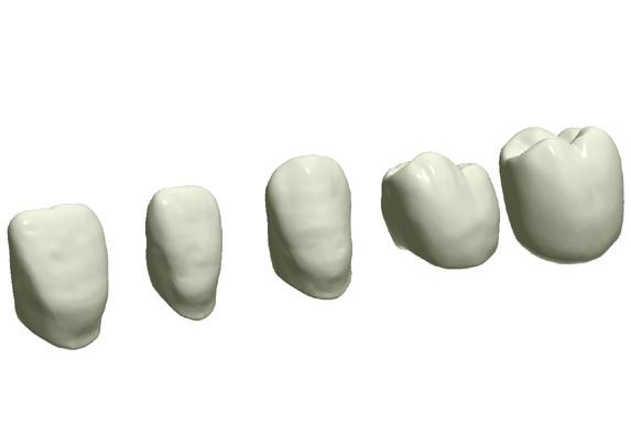 Automazione della corona DentalDesigner esegue automaticamente una modellazione preliminare dell autonomia del dente