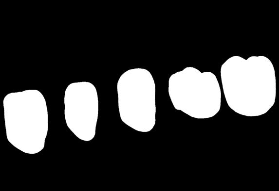 Morfologie personalizzate 3Shape riconosce l unicità di ciascun dente.