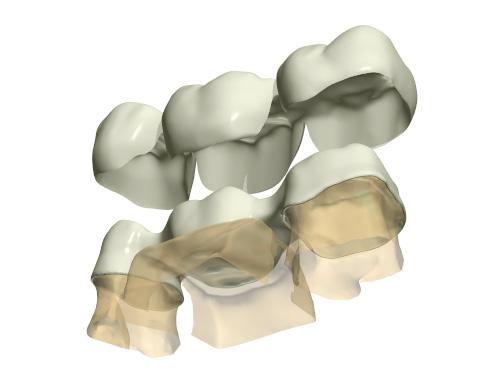 CERAMICA PRESSATA 3SHAPE DENTAL SYSTEM Ceramica pressata in DentalDesigner Aumento della produttività tramite rivestimenti, intarsi, corone e
