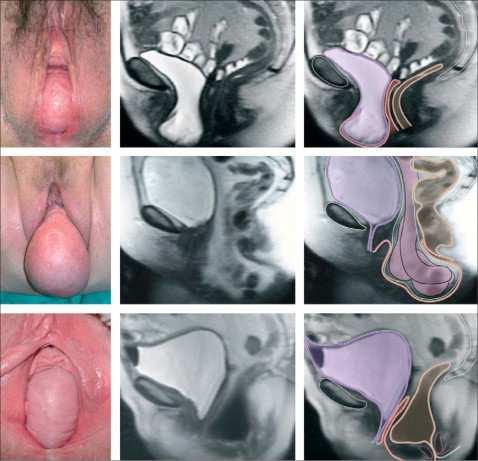 PELVIC ORGAN PROLAPSE IS DOWNWARD DESCENT OF FEMALE PELVIC ORGANS INCLUDING THE BLADDER, UTERUS OR POSTHYSTERECTOMY